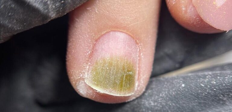 Zielona bakteria na paznokciu — co zrobić przed stylizacją?