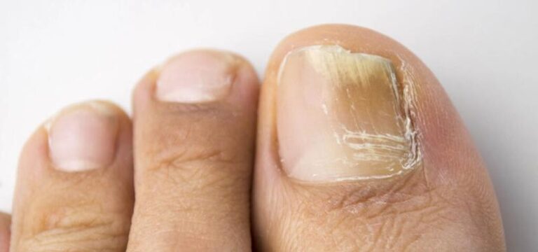 Jak skutecznie wyleczyć grzybicę paznokci i odzyskać zdrowe dłonie?