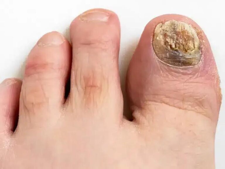 Jakie zagrożenia niesie za sobą grzybica paznokci?