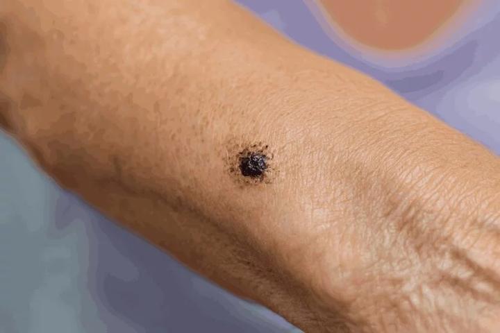 Czy czerniak paznokcia można skutecznie wyleczyć? Sprawdzamy fakty i mity